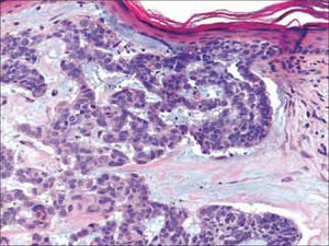 Adenoideo.