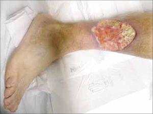 Pioderma Gangrenoso en paciente con Colitis Ulcerosa.