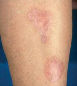 Necrobiosis Lipoidea.