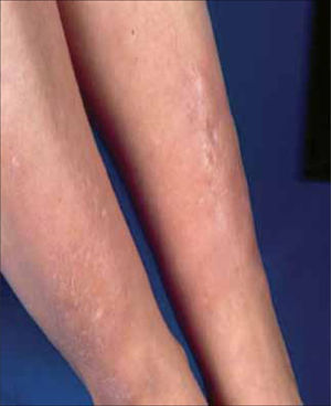 Mixedema pretibial.