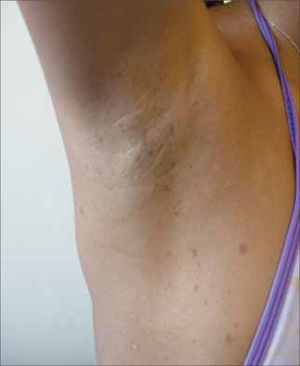 Neurofibromatosis: signo de Crowe.