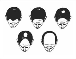 Clasificación de Hamilton-Ebling. Fuente: Bertolino A, Freedberg I. Dermatología en Medicina General. “Pelo”. Fitzpatrick y cols. Capítulo 65, páginas 757-781.