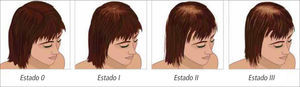 Clasificación de Ludwig modificada. Fuente: Guerrero R, Loubies R, Baeza S, Álvarez M. Rev Chilena Dermatol 2007; 23(1): 20-27.