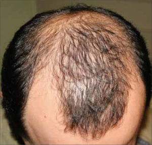 Alopecia androgenética masculina.