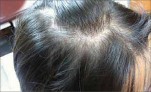 Alopecia difusa en la mujer joven.