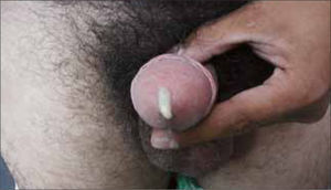 Gonorrea en varón.
