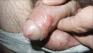 Herpes qenital varón.