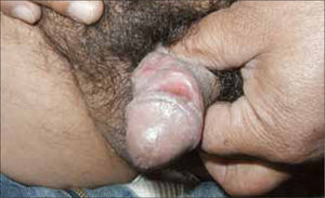 Sífilis Primaria: chancro doble.