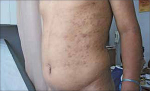 Sífilis Secundaria. Exantema máculo-papular en tórax, vdrl 1/256.