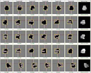 Campos multisegmentados de intensidad modulada. La sumatoria de los segmentos resulta en campos que presentan puntos de distinta exposición y que son complementarios entre sí para lograr los objetivos de dosis en blancos y zonas protegidas.