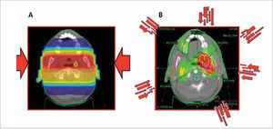 A. Dosimetría de un paciente de cáncer de amígdala con planificación 2-D convencional usando campos paralelos opuestos y boost convencional. B: El mismo paciente con un plan de intensidad modulada en que múltiples haces de diferentes intensidades inciden desde distintos ángulos para esculpir una distribución de dosis con protección del cerebro, tronco encefálico, mandíbulas, mucosa oral y glándulas parótidas.