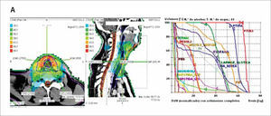 Radioterapia de intensidad modulada en cáncer tiroideo. A: Distribución de dosis en diferentes tejidos, con protección medular y esofágica, y dosis adecuadas en lecho tiroideo cuello anterior.