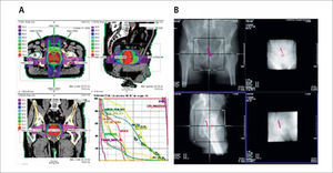 IMRT prostática. A: Distribución de dosis en planos axial, lateral y coronal e histograma dosis/volumen en radioterapia prostática con intensidad modulada. B: Posicionamiento guiado por imágenes portales con fiduciarios implantados en próstata.
