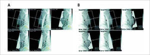 A: Segmentos laterales y B: segmentos mediales conformados con colimador de multiláminas utilizados para obtener volúmenes de radiación homogéneos en IMRT mamaria.