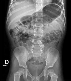 Rx de abdomen revela gran vejiga y falta de fusión de los arcos posteriores de múltiples vértebras lumbares y sacras, concordantes con meningocele.