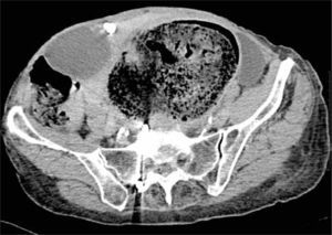 Corte axial de tc a nivel de la pelvis. Se observa gran fecaloma que se extiende hacia la pared anterior, desplazando el útero y vejiga hacia la fosa ilíaca derecha. Mioma calcificado.