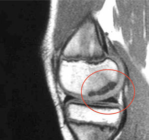 El mismo caso de la Figura 9. La RM demuestra lesión estable por indemnidad del cartílago articular.