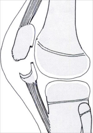 Avulsión polo inferior de la rótula. (Reproducido de: Houghton GR, Ackroyd CE: Sleeve fractures of the patella in children: a report of three cases J Bone Joint Surg 61B:165, 1979.)