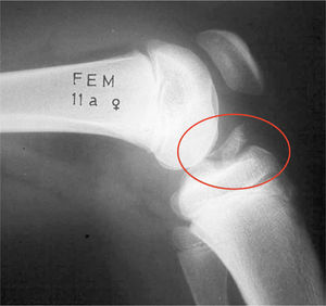 Fractura desplazada de espina tibial anterior.