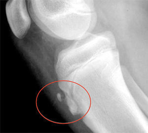 Calcificación residual en inserción de tendón rotuliano como secuela de Osgood Schlatter.