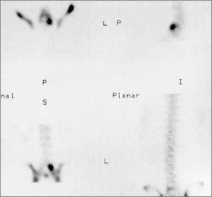 Captación elevada del radiofármaco en el arco posterior (pars interarticular) L5 en un adolescente con dolor lumbar en la extensión y radiografía que resultó sospechosa de lisis.
