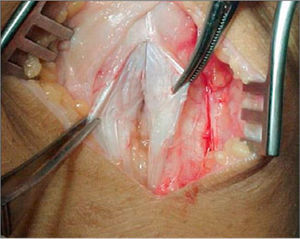 Resección tejido fibroso degenerativo del tendón.