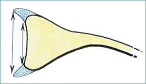 Esquema que ilustra la posición y el efecto estabilizador del labrum sobre el reborde glenoideo.