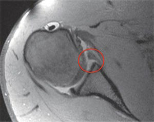 Cortes axiales de resonancia magnética donde se observa un desprendimiento del labrum glenoideo en su porción anterior (círculo).