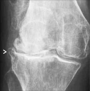 Rx AP de pie de rodilla con artropatía degenerativa. Muestra osteopenia difusa, reducción asimétrica de espacios articulares femorotibiales, mayor en compartimento lateral, esclerosis subcondral (*) y desarrollo osteofítico marginal (>).