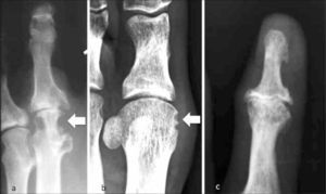 A.- Paciente con AR. Erosiones marginales. (flecha). B.- Paciente con Gota. Rx ortejo mayor con erosiones en sacabocado en el aspecto medial de cabeza del 1er metatarsiano (flecha). C.-Erosiones centrales con deformidad en “alas de gaviota” en una artrosis erosiva.