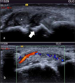 A.-US muestra presencia de erosión (flecha) adyacente a un tofo (*) en un paciente con gota. B.-US con Doppler color, evidenciando sinovitis con aumento de vascularización.