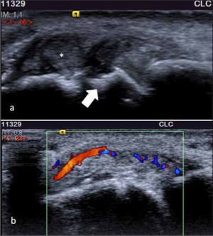 A.-US muestra presencia de erosión (flecha) adyacente a un tofo (*) en un paciente con gota. B.-US con Doppler color, evidenciando sinovitis con aumento de vascularización.