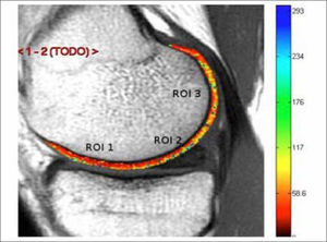 RM con Mapa T2 de cartílago de cóndilo femoral.