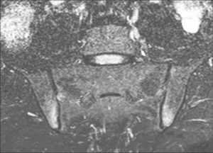 RM coronal secuencia STIR de articulaciones sacroilíacas, con disminución de amplitud, edema óseo e incipientes erosiones.