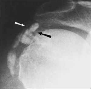 Depósitos de calcio en tendón del supraespinoso (flecha blanca) y bursa subdeltoídea (flecha negra). Primer on the Rheumatic Diseases Therteenth editon, Chapter 3; 71.