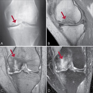 Necrosis avascular de cóndilo femoral interno A: Radiografía rodilla izquierda muestra una lesión radiolúcida subcondral, rodeada por un halo de esclerosis, en cóndilo femoral interno. B, C D: RNM muestra edema óseo y colapso de la superficie articular. José María Mellado Santos et al. Sociedad Española de Radiología Médica