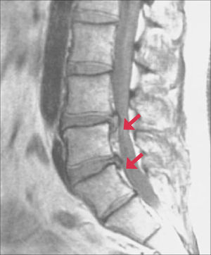 RNM de HNP L3-L4 y L4-L5. Primer on the Rheumatic Diseases Therteenth editon, Chapter 3; 62