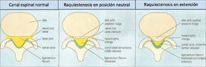 Esquema de Raquiestenosis en posición neutra y extensión de columna.