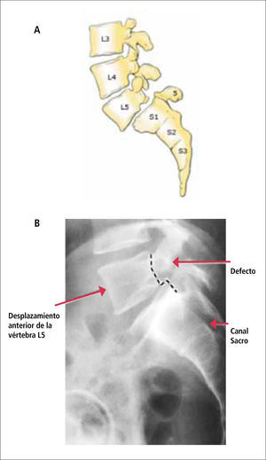 Espondilolistesis L5 sobre S1.