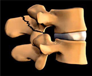 Lesión de la Pars Interarticularis.