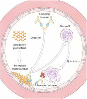 Depósito de complejos inmunes en la pared del endotelio, que activan la cascada de la coagulación y el complemento, generando sustancias quimiotácticas para neutrófilos. Estos dañan directamente las paredes vasculares por acción de sus enzimas. (adaptado de 12).