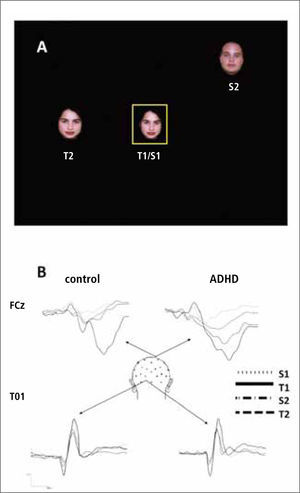 B. Potenciales evocados generados durante la tarea. Arriba, el potencial P300 (electrodo FCz). En los controles, se observa este potencial (deflexión hacia abajo) sólo con el estímulo T1, que es el que debía ser atendido por el sujeto. Sin embargo, en el grupo TDAH (ADHD en inglés) se ve claramente que los estímulos periféricos, S2 y T2, producen también un P300 significativo, indicando que éstos sujetos no logran suprimir adecuadamente a los estímulos distractores. Los potenciales señalados mas abajo (electrodo T01) son potenciales sensoriales evocados en la corteza visual. Para mas detalles, ver (37).