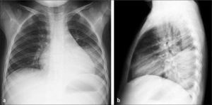 Neumonía de lóbulo inferior izquierdo; a) Rx frontal, b) Rx lateral.