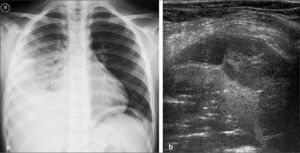 Pleuroneumonía derecha con derrame loculado. a) Rx simple, b) US.