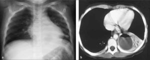 Antiguo caso de absceso pulmonar en neumonía de LII; escolar de 6 años previamente sano. a) Rx AP decúbito, b) TC con contraste.