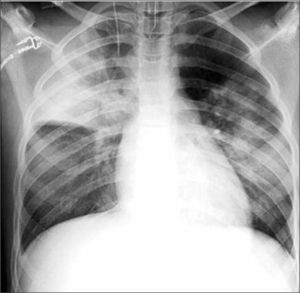 Neumonía alveolar multifocal en niño de 14 años, con broncograma aéreo en su espesor.