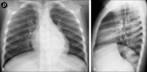 Neumonía retrocardíaca izquierda: proyección frontal (a) y lateral (b).