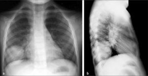 Neumonía redonda en paciente de 5 años a) Rx frontal, b) Rx lateral.