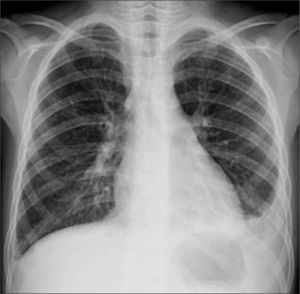Neumonía basal izquierda, asociada a pequeño derrame pleural que ocupa el receso costofrénico lateral.