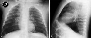 Lactante de 8 meses con severa hiperinsuflación pulmonar bilateral y compromiso intersticial pulmonar. a) Rx AP, b) Rx lateral.